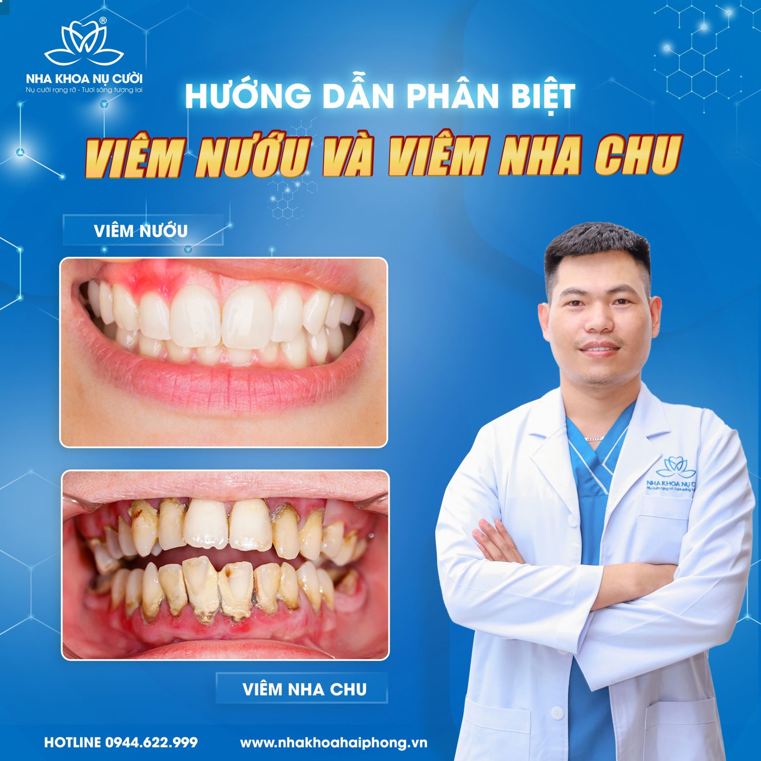 Hướng dẫn phân biệt viêm nướu và viêm nha chu