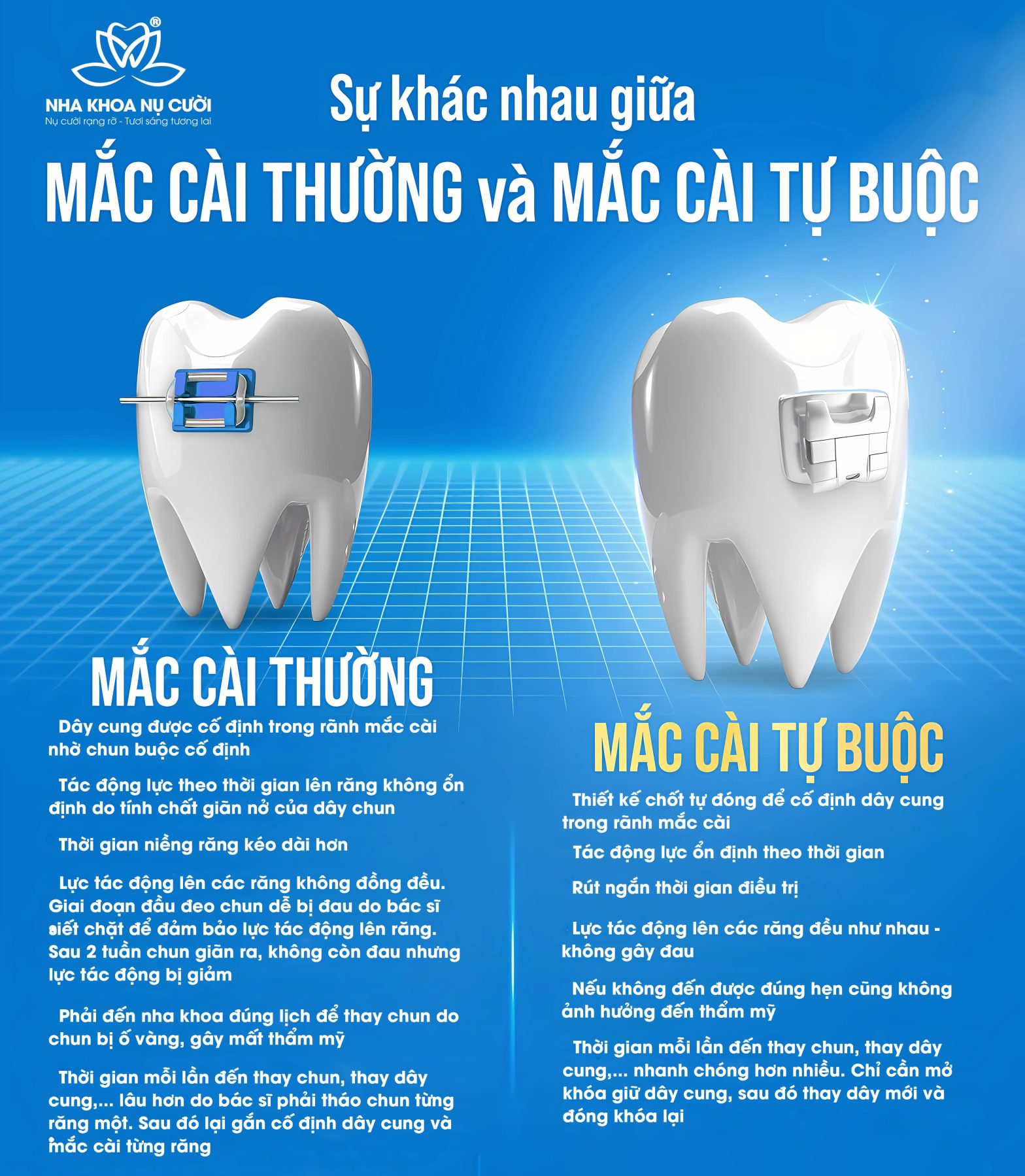 Sự Khác Nhau Giữa: Mắc Cài Thường Và Mắc Cài Tự Buộc