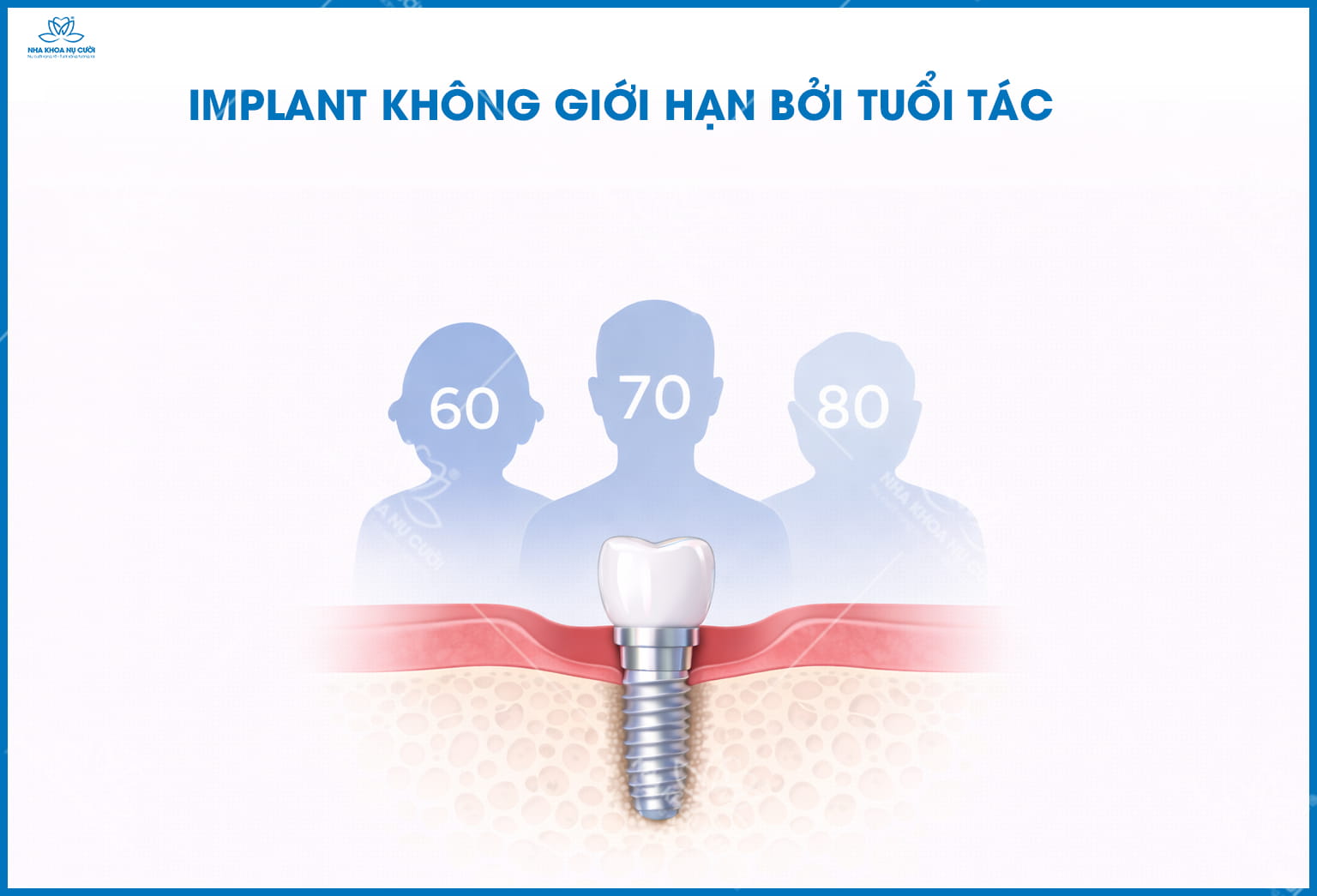 Trồng răng Implant Hải Phòng – Phục hồi răng mất bền vững