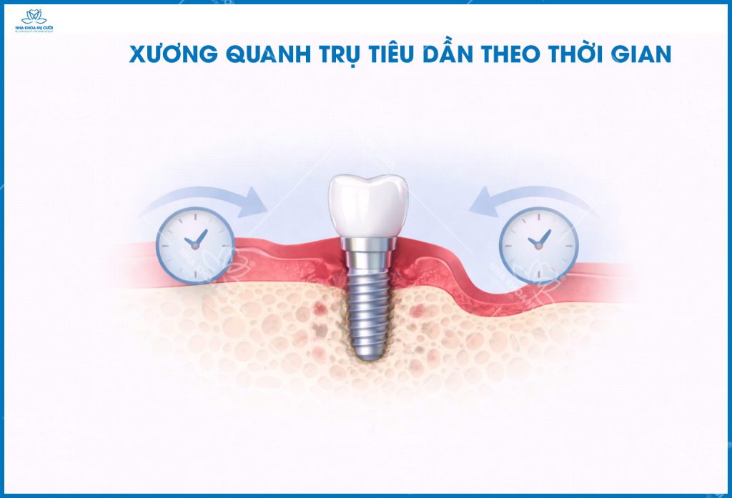 implant