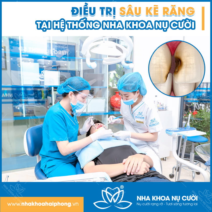 Sâu kẽ răng – Khó phát hiện nhưng dễ nguy hiểm