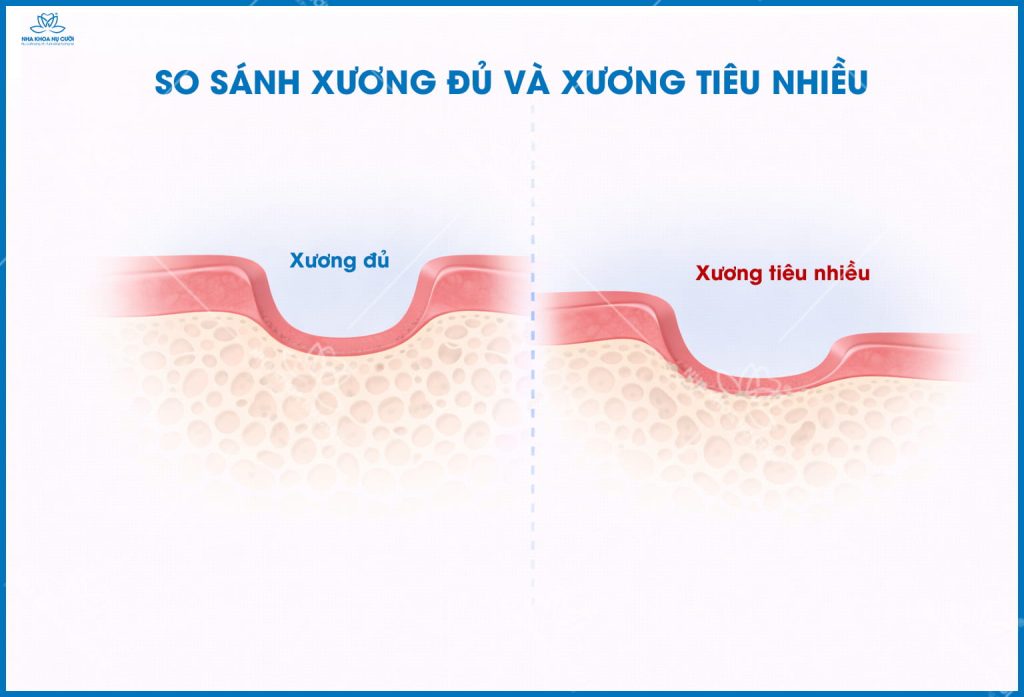 so-sanh