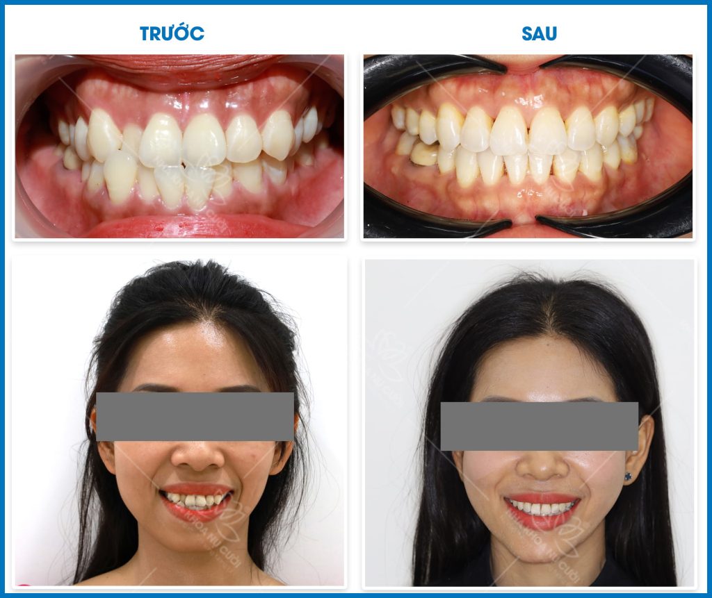 ket-qua-truoc-sau