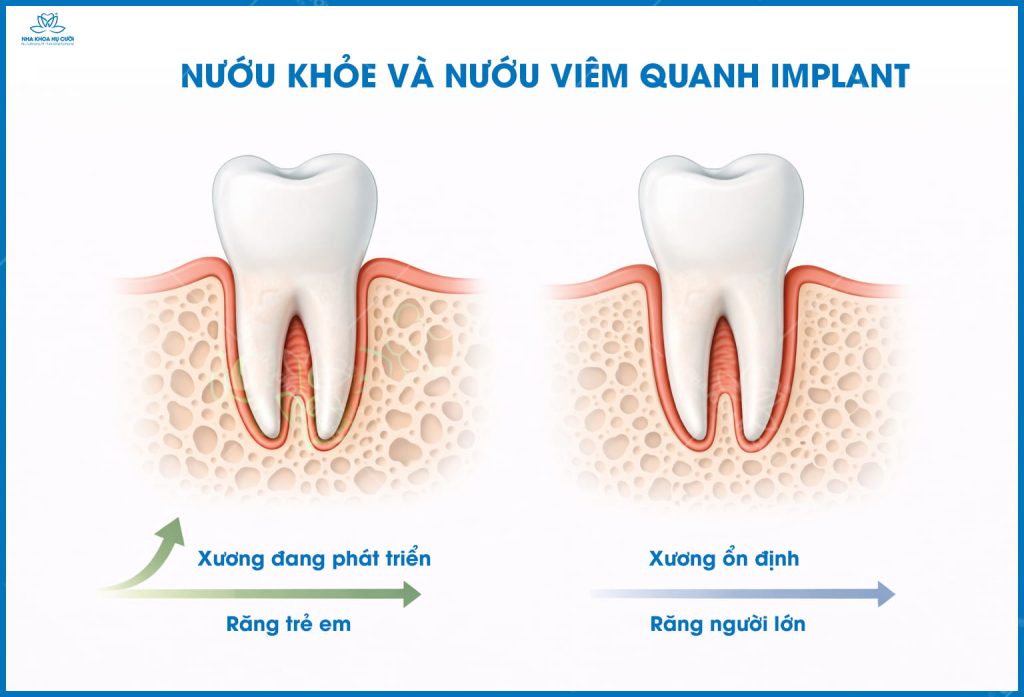 so-sanh-xuong