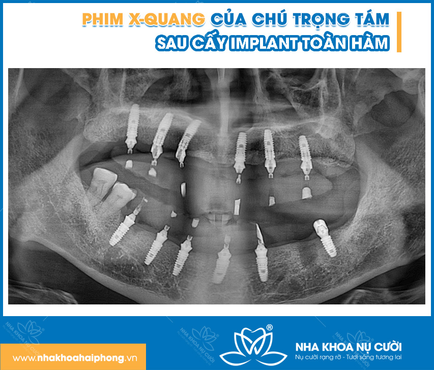 implant