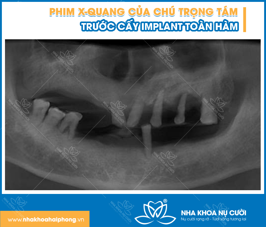 implant