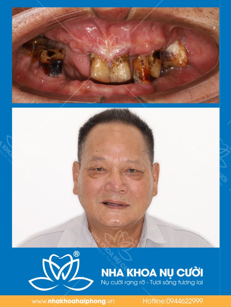 IMPLANT