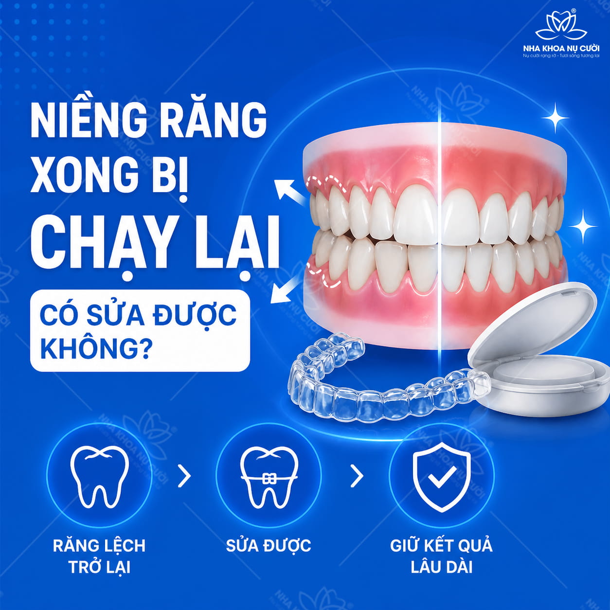 Niềng răng xong bị chạy lại – có sửa được không? Cách xử lý đúng