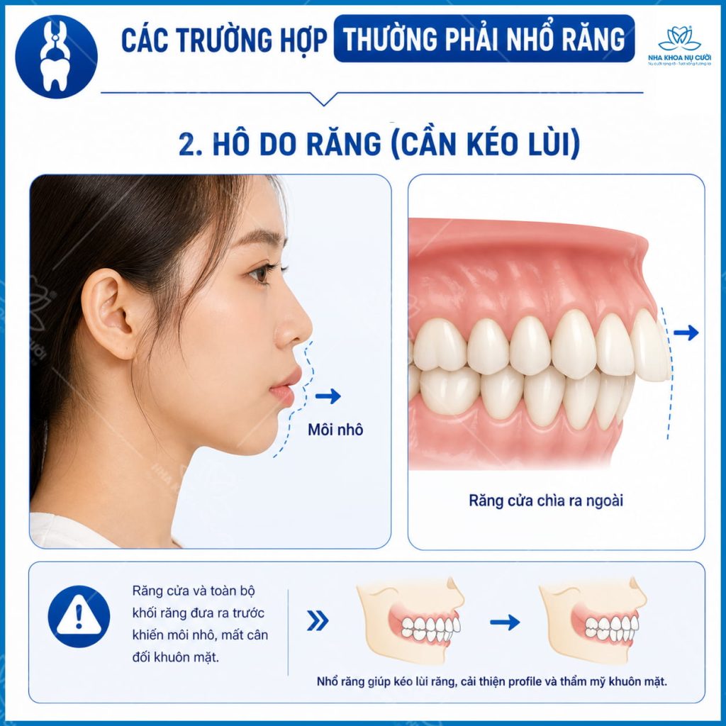 cac-truong-hop-nieng-can-nho-rang