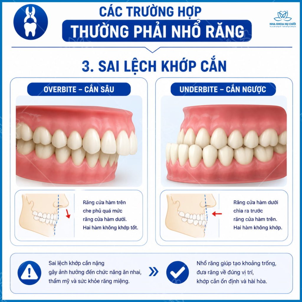 cac-truong-hop-nieng-can-nho-rang