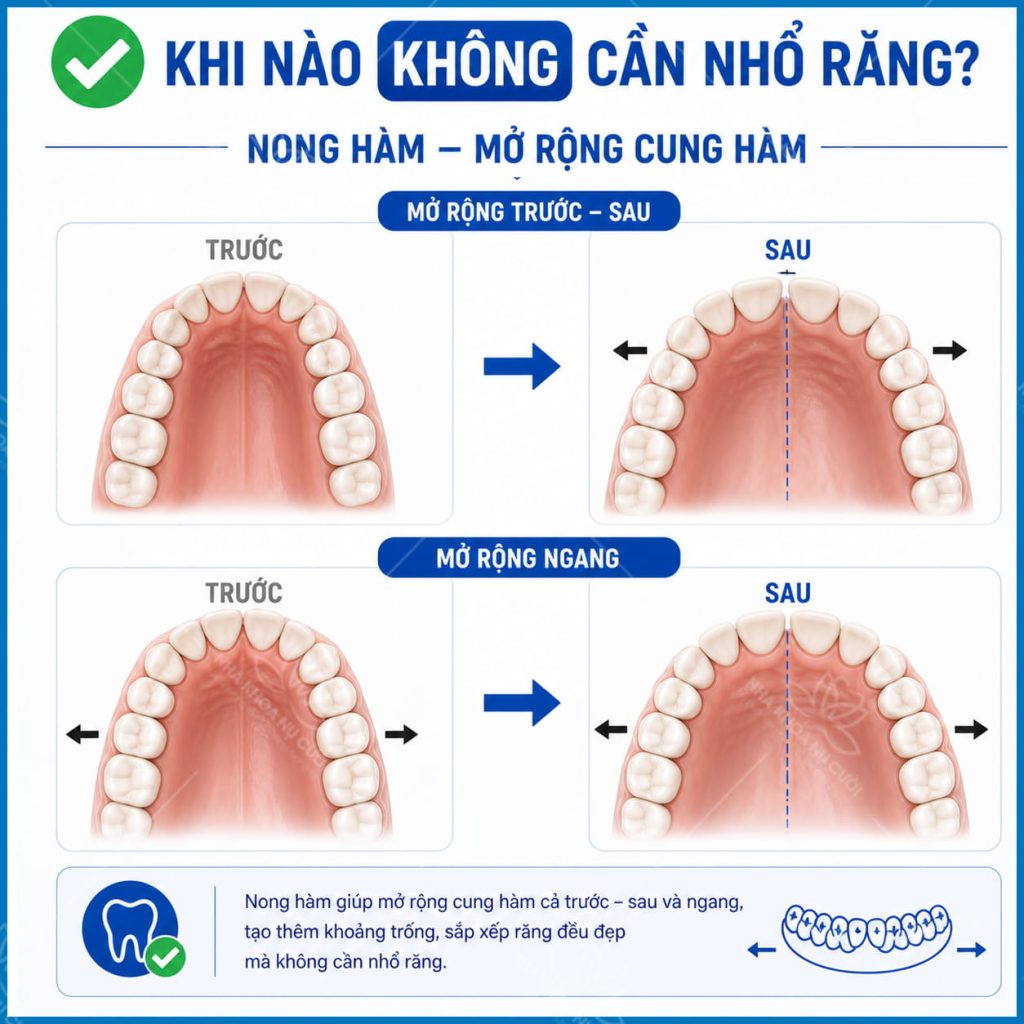 cac-truong-hop-nieng-khong-can-nho-rang
