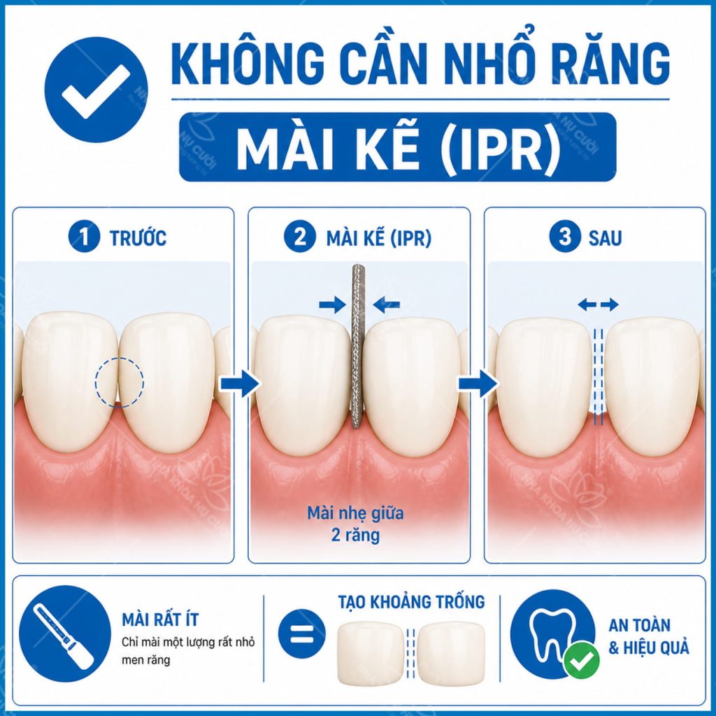 cac-truong-hop-nieng-khong-can-nho-rang
