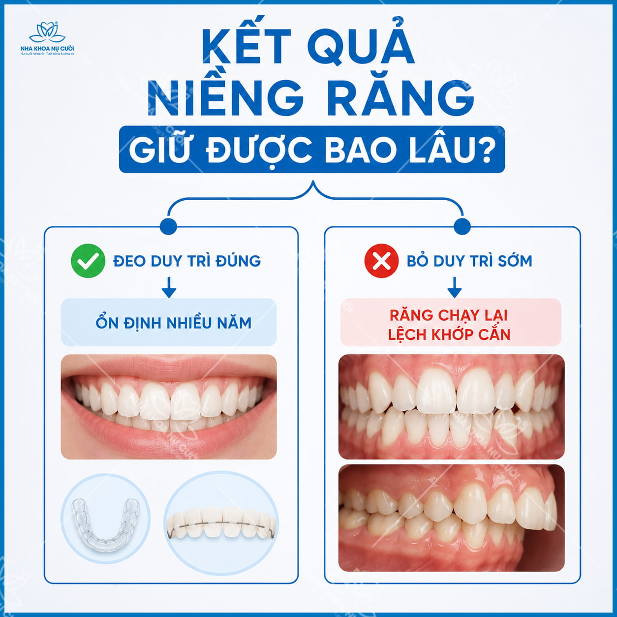 Kết quả niềng răng giữ được bao lâu? Vì sao răng vẫn chạy lại?