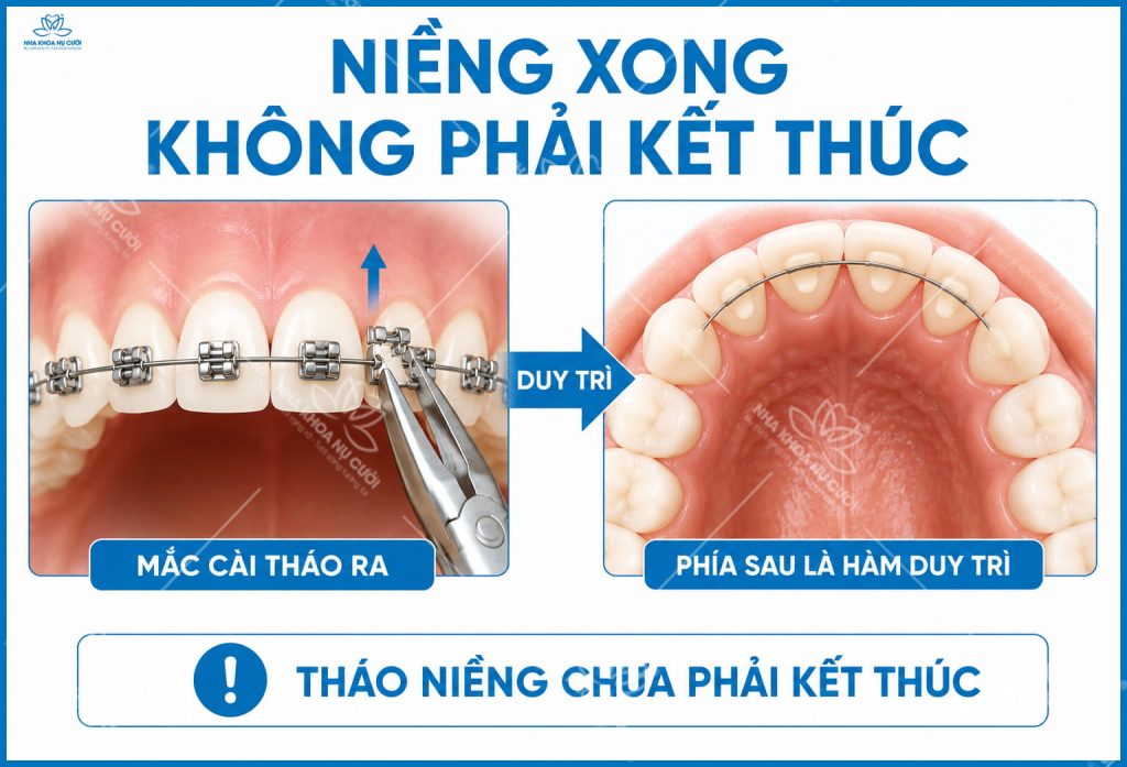 ket-qua-nieng-rang-giu-duoc-bao-lau.