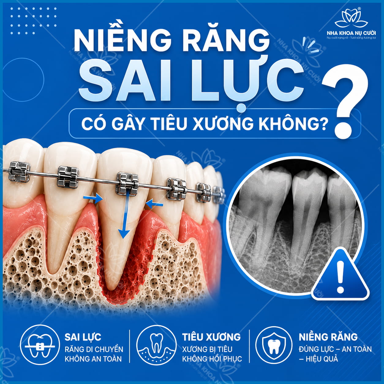 Niềng răng sai lực có gây tiêu xương không? Dấu hiệu & cách phòng tránh