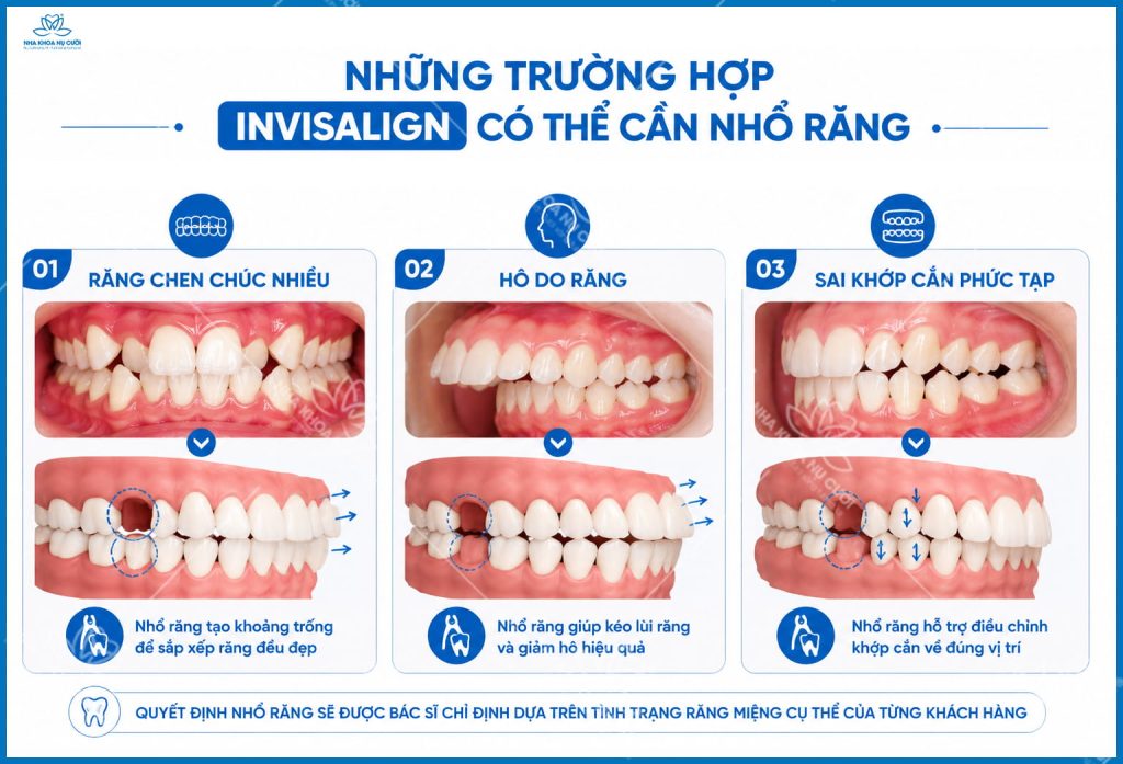 invisalign-co-phai-nho-rang