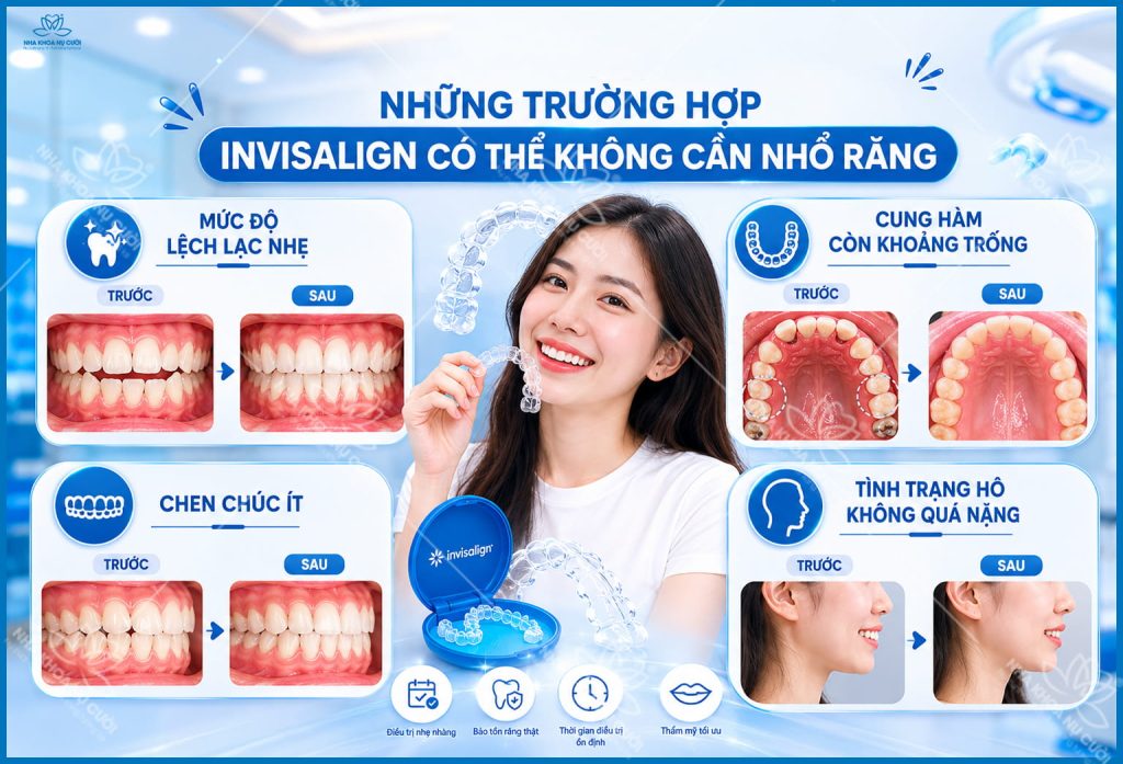 invisalign-co-phai-nho-rang