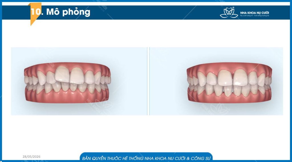 khach-hang-invisalign