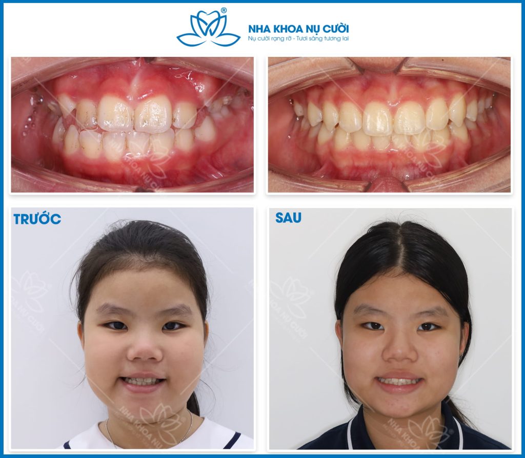 Invisalign-first-hai-phong