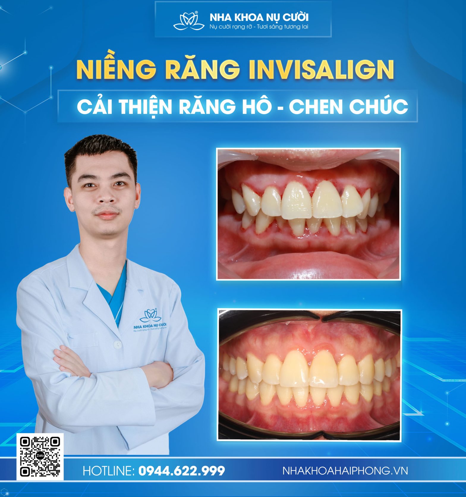 Hành trình Invisalign cải thiện hô, chen chúc không nhổ răng tại Hải Phòng