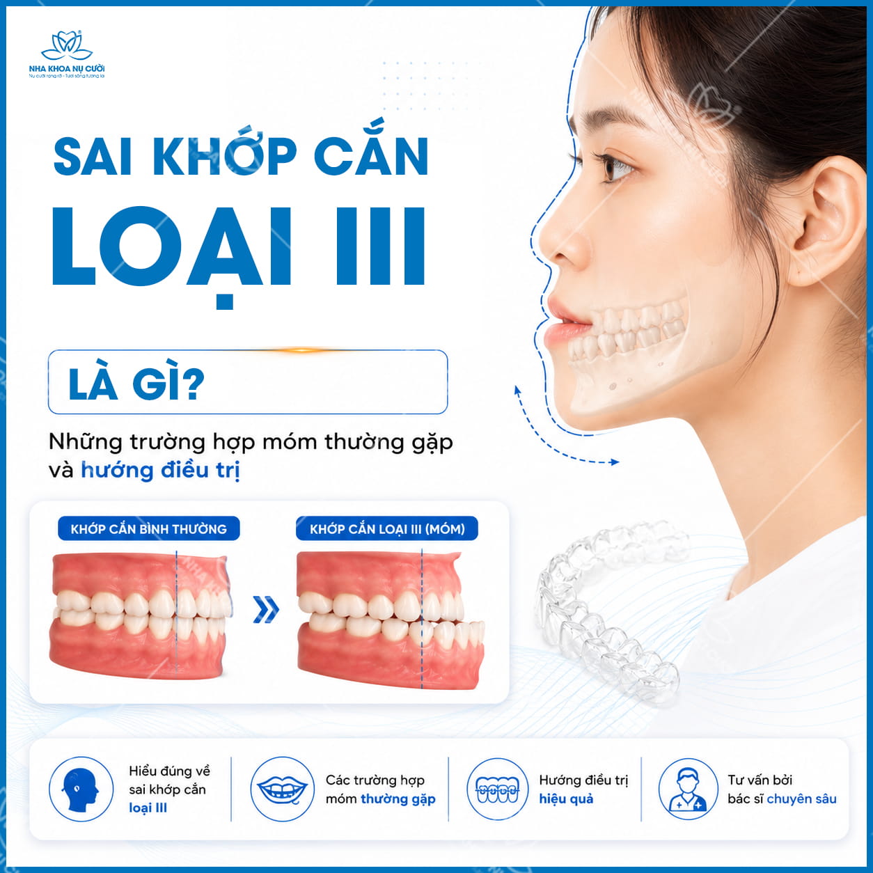 Sai khớp cắn loại III là gì? Những trường hợp móm thường gặp và hướng điều trị