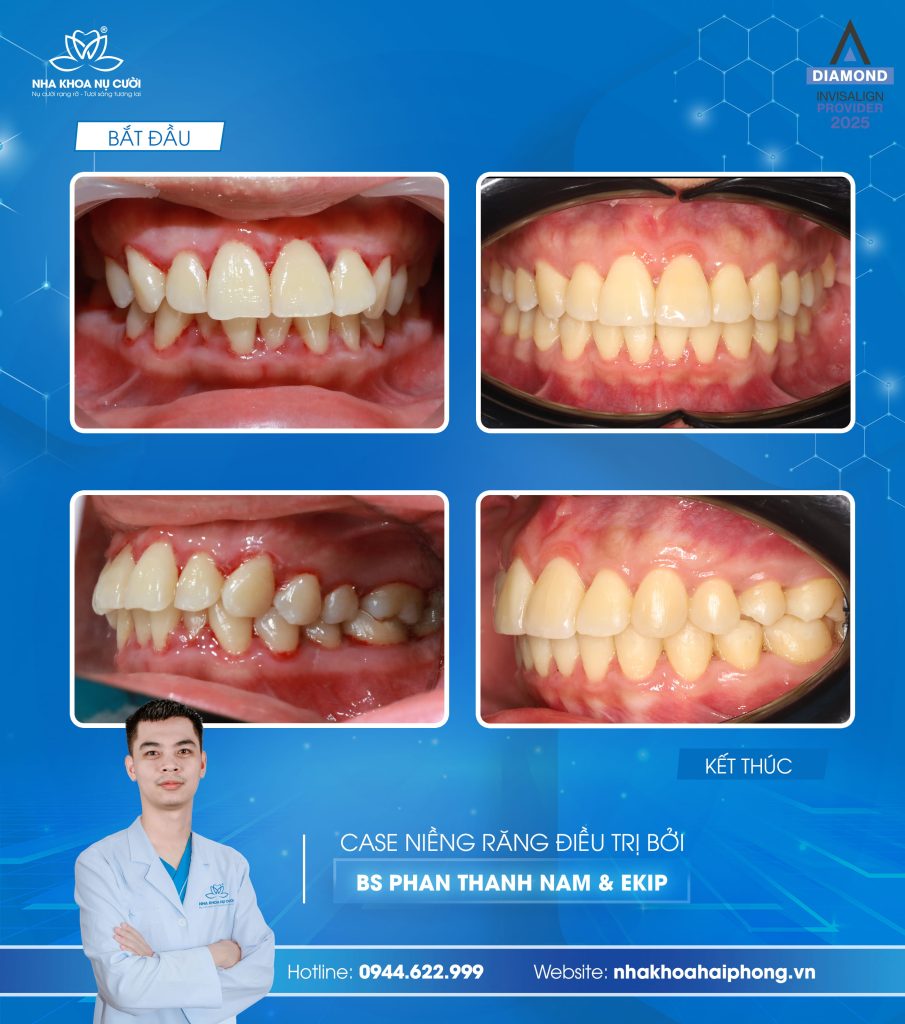 invisalign-cai-thien-ho
