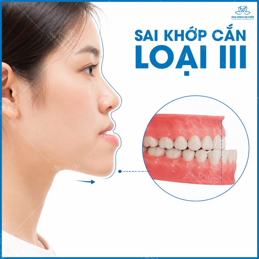 sai-khop-can-loai-III-hai-phong