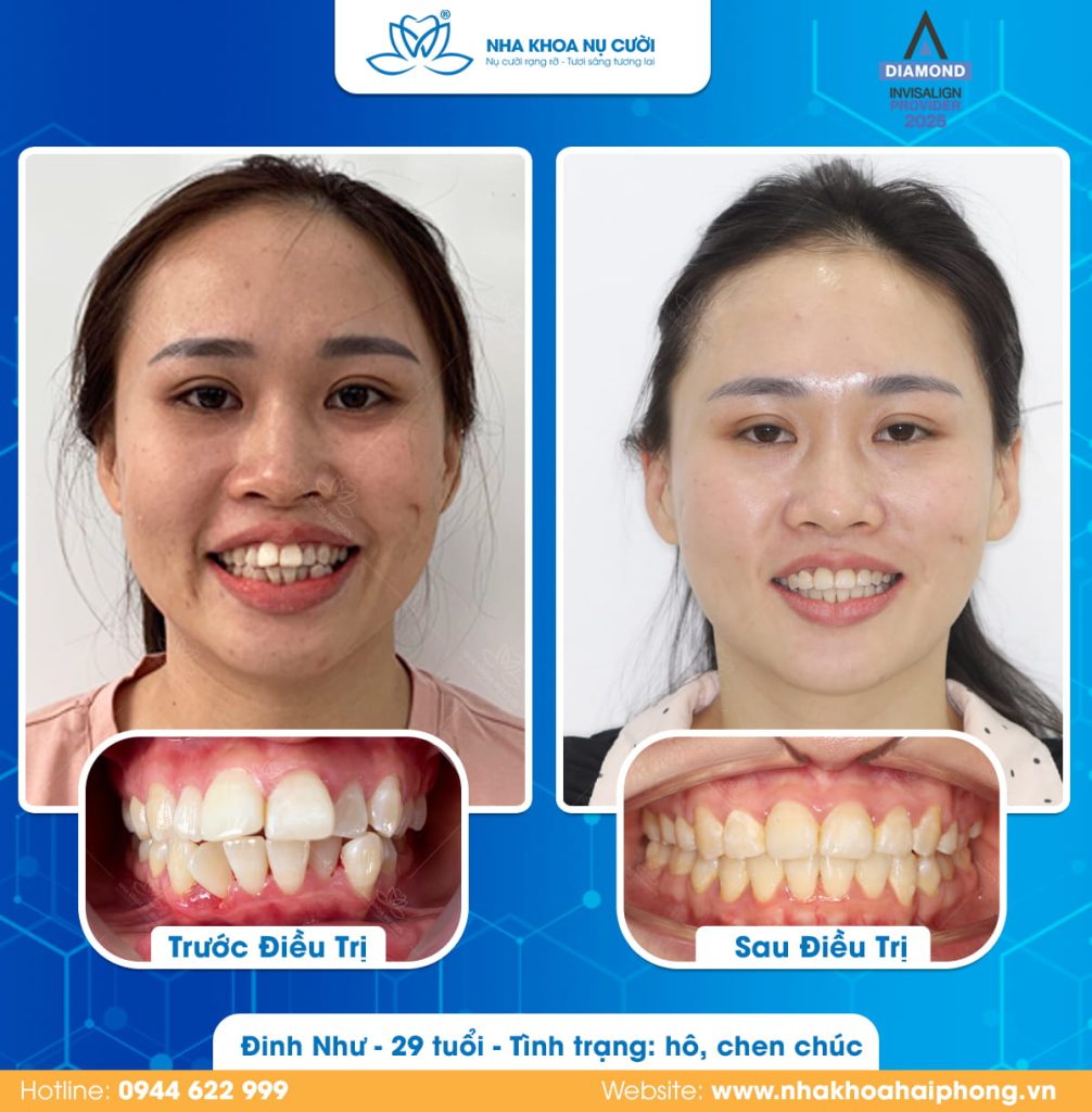 Dinh-nhu-invisalign-Hai-phong