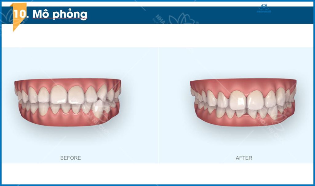 clincheck-invisalign-hai-phong