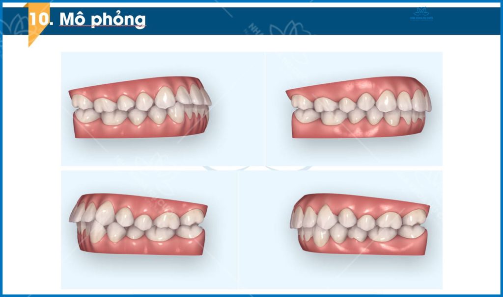 clincheck-invisalign-hai-phong