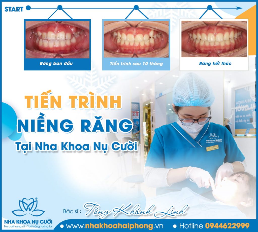 Invisalign-first-hai-phong