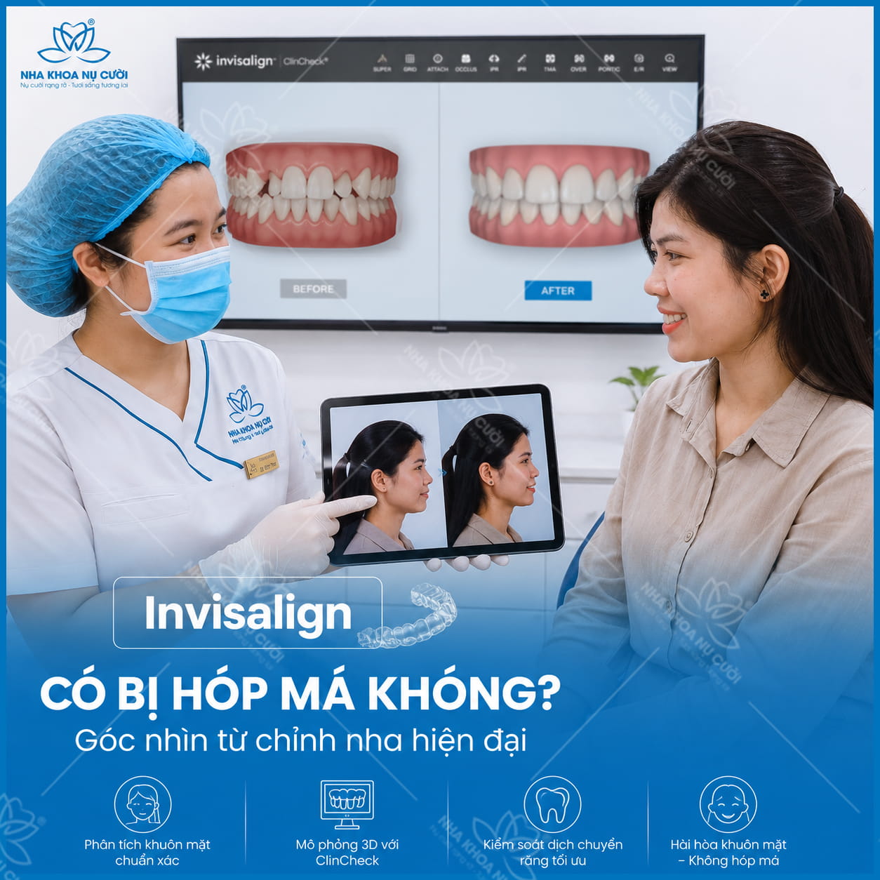 Invisalign có bị hóp má không? Vì sao nhiều khách hàng lo lắng về thay đổi khuôn mặt khi chỉnh nha?