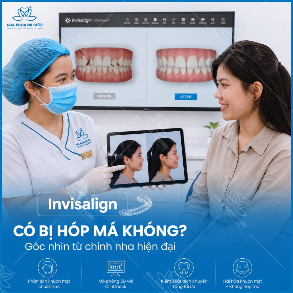 invisalign-hop-ma-hai-phong.