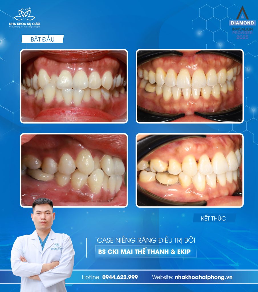 invisalign-cai-thien-chen-chuc