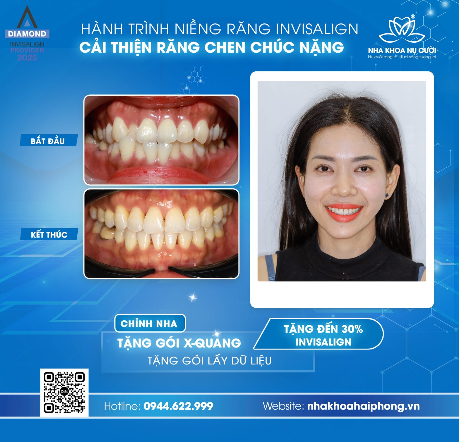 Hành trình Invisalign cải thiện chen chúc nặng của khách hàng nữ 34 tuổi tại Hải Phòng