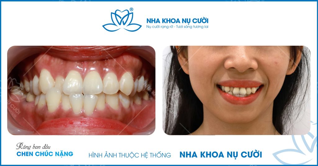 invisalign-cai-thien-chen-chuc
