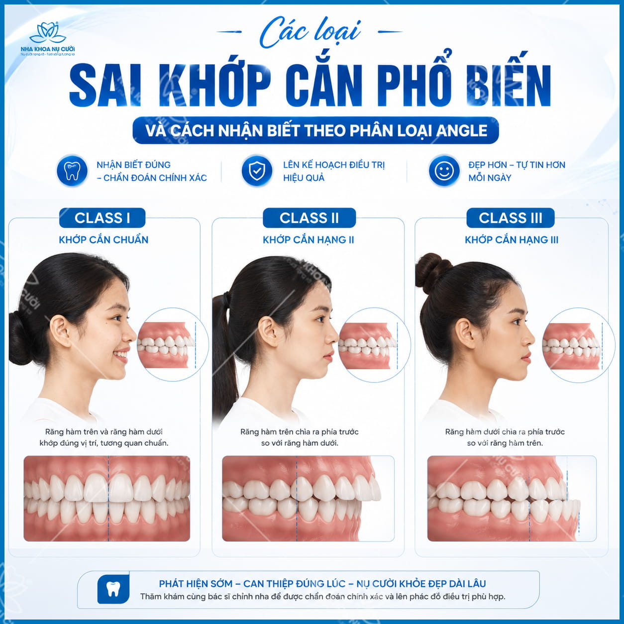 Các loại sai khớp cắn phổ biến và cách nhận biết theo phân loại Angle