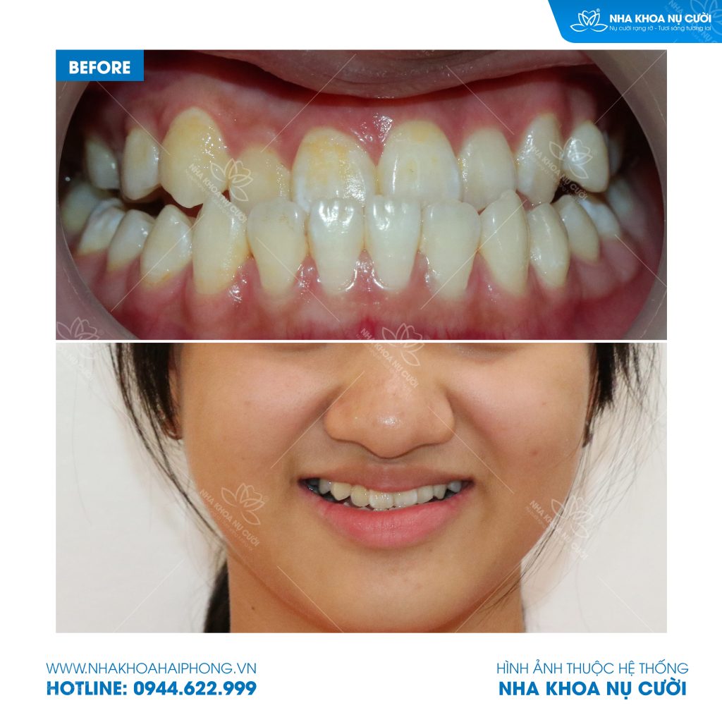 invisalign-cai-thien-mom-nhe