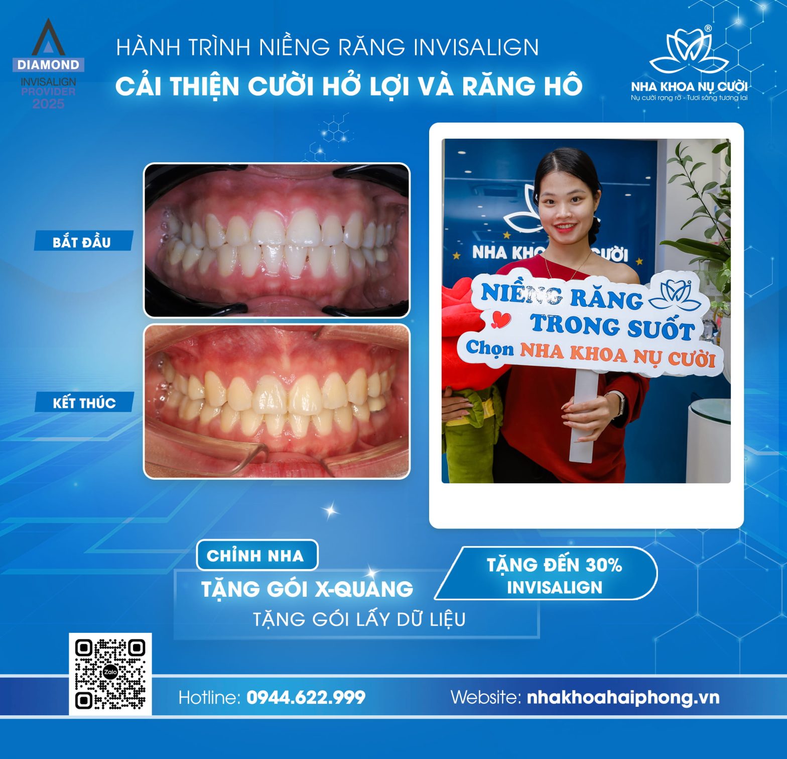 Hành trình Invisalign cải thiện cười hở lợi và hô của khách hàng nữ 26 tuổi tại Hải Phòng