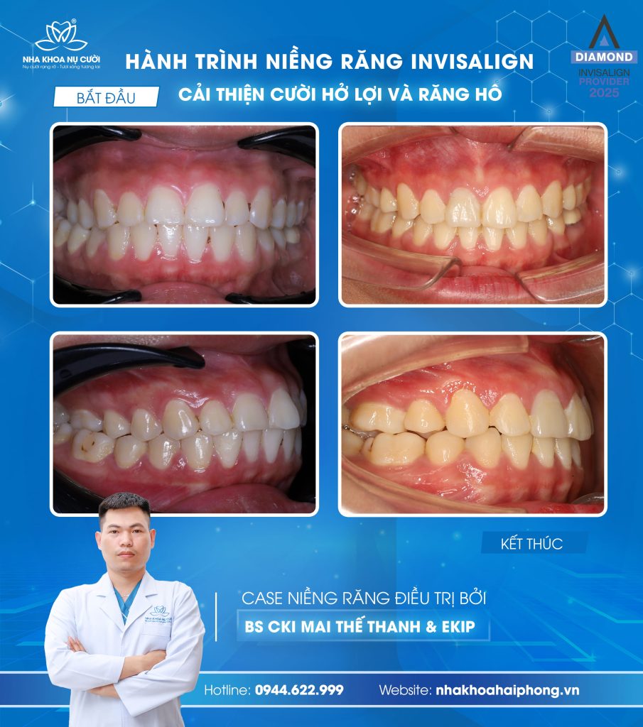 cuoi-ho-loi-rang-ho-nha-khoa-nu-cuoi-hai-phong