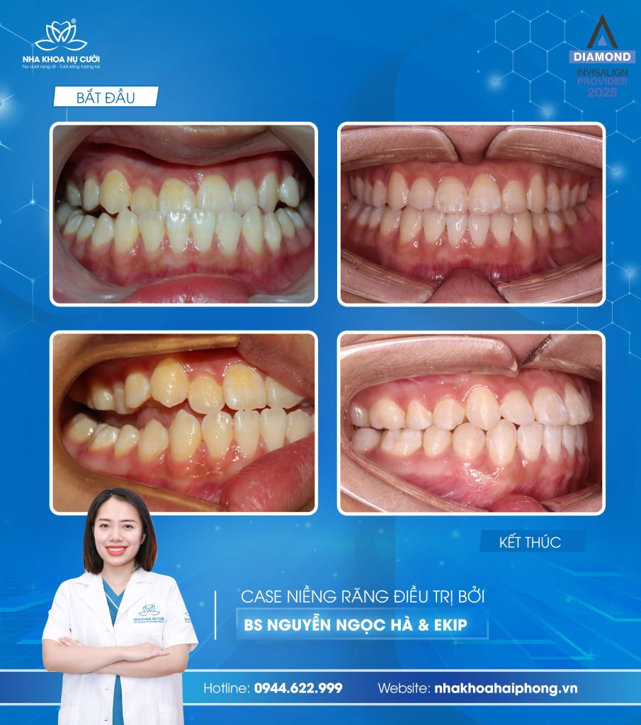 invisalign-cai-thien-mom-nhe