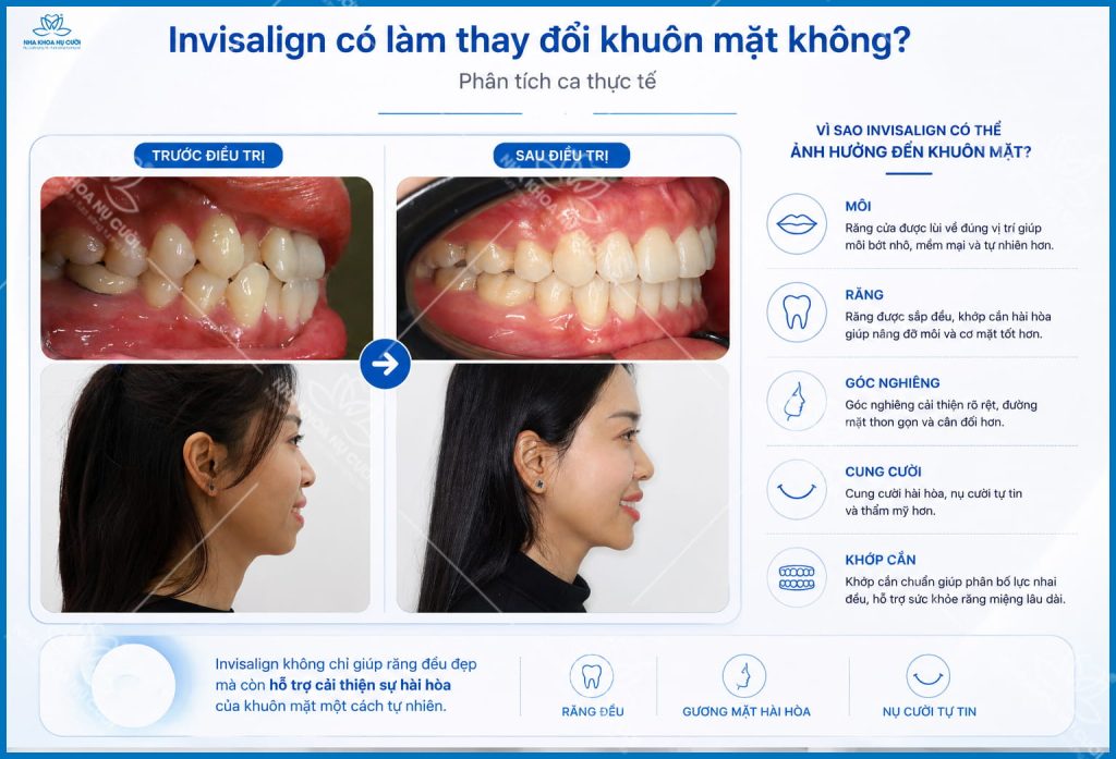 invisalign-thay-doi-khuon-mat-hai-phong