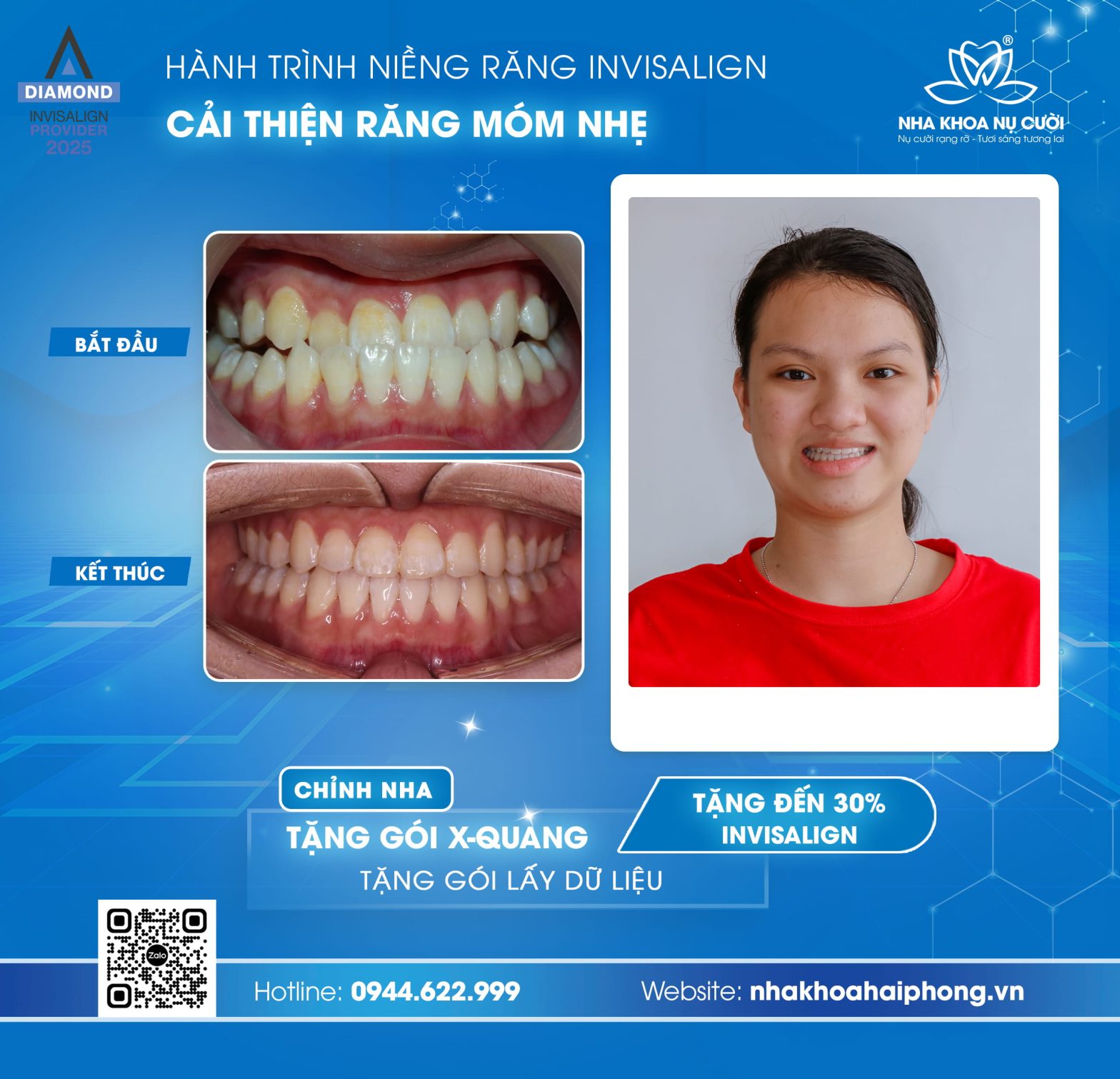 Hành trình Invisalign cải thiện móm nhẹ của khách hàng nữ 30 tuổi tại Hải Phòng