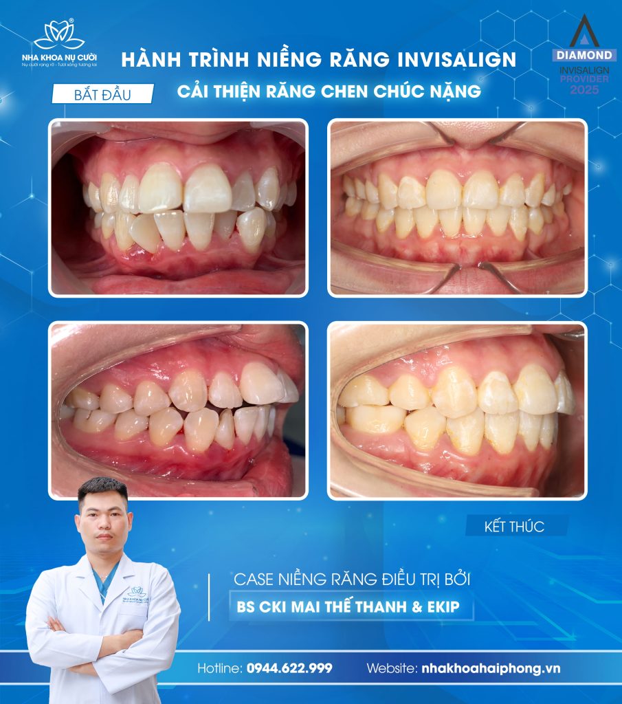 invisalign-hai-phong-cai-thien-chen-chuc-ket-hop-can-sau-