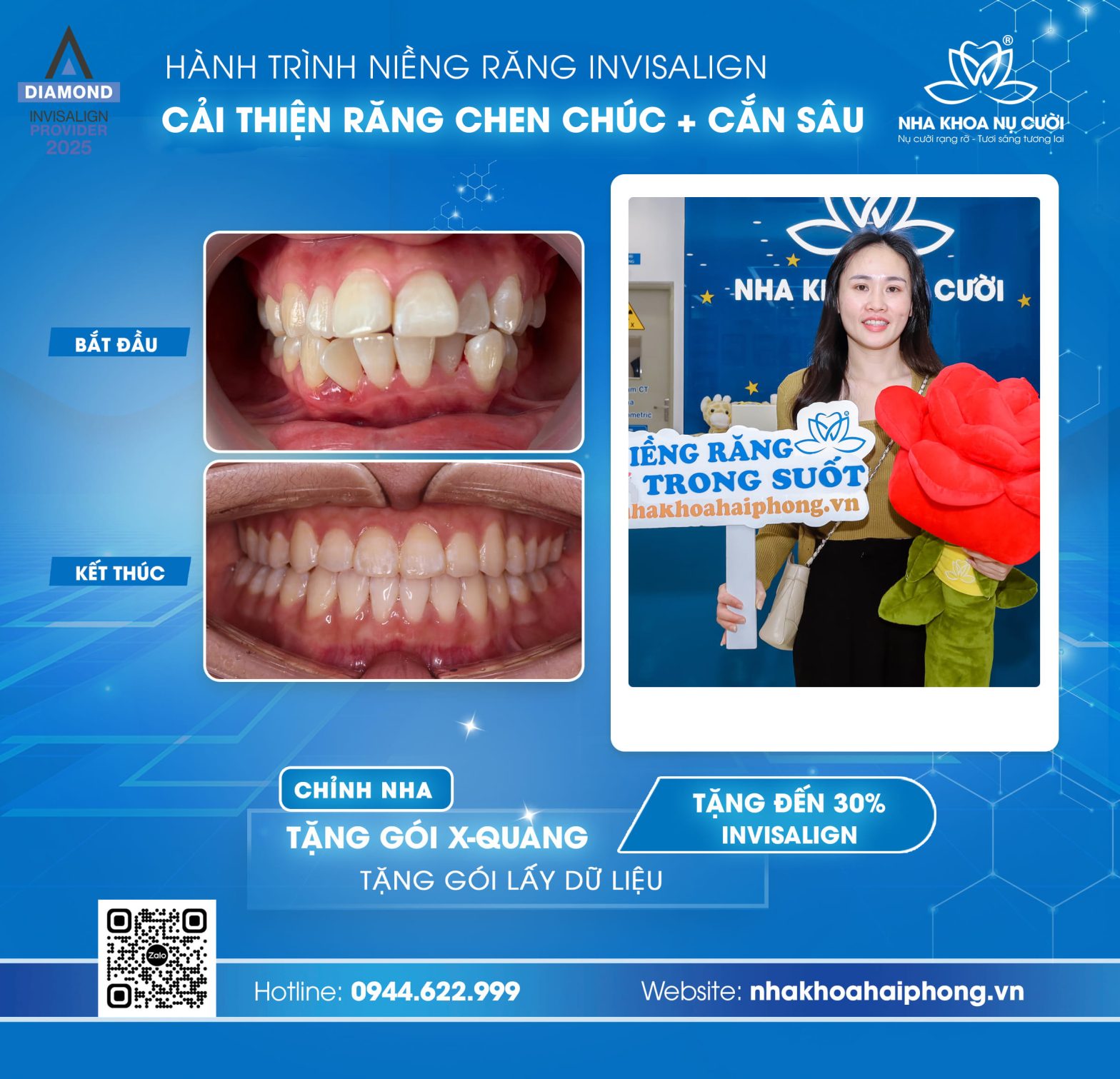 Hành trình Invisalign cải thiện chen chúc kết hợp khớp cắn sâu của khách hàng nữ 29 tuổi tại Hải Phòng