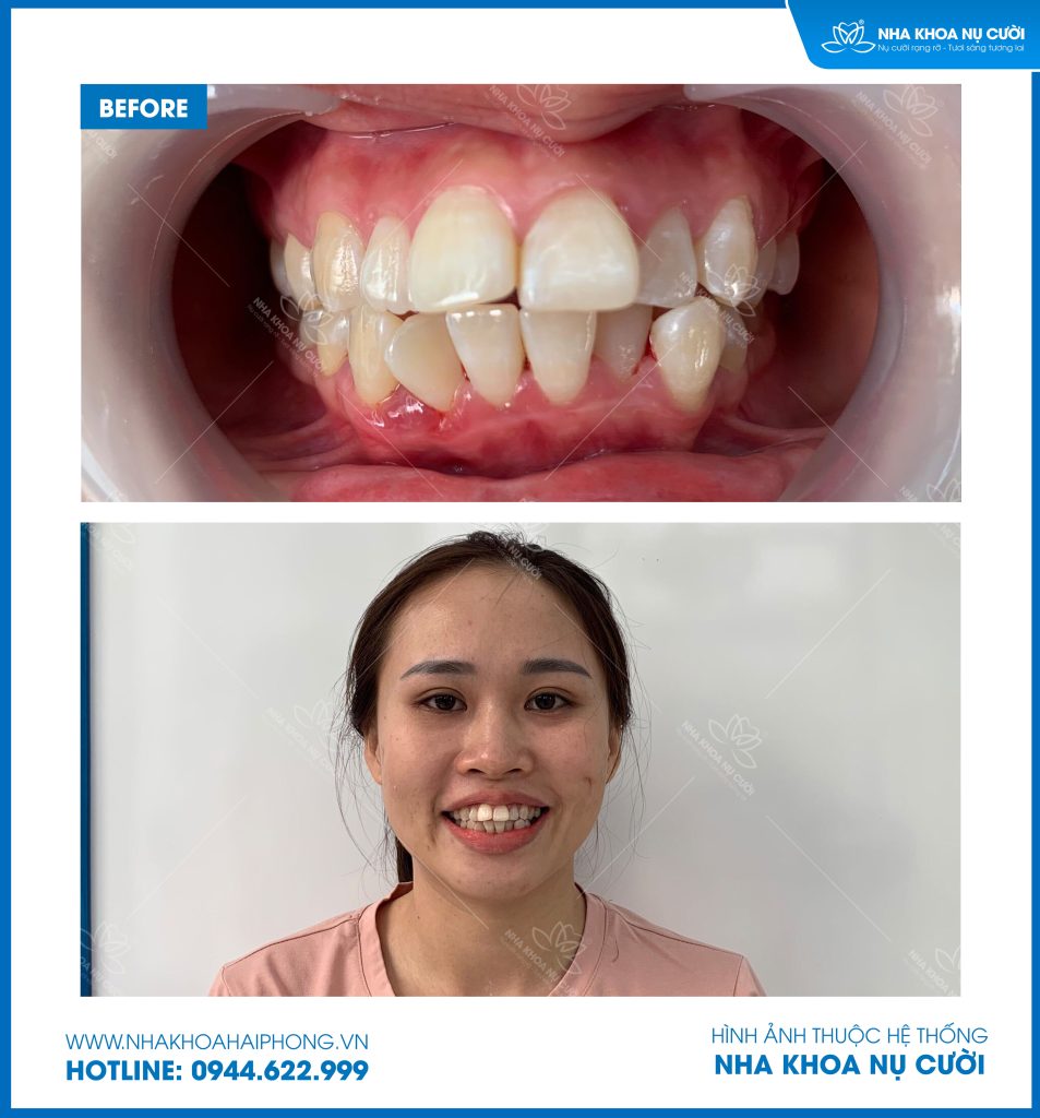 invisalign-hai-phong-cai-thien-chen-chuc-ket-hop-can-sau-