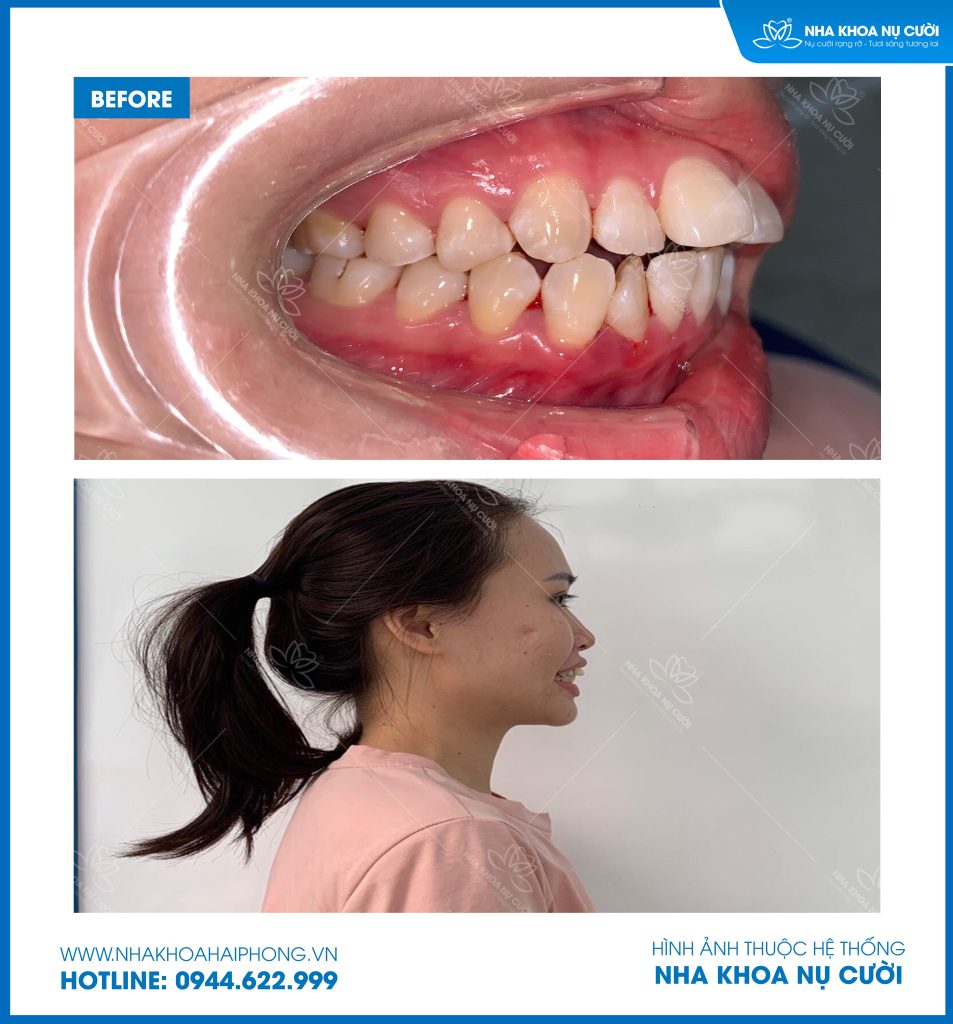 invisalign-hai-phong-cai-thien-chen-chuc-ket-hop-can-sau-