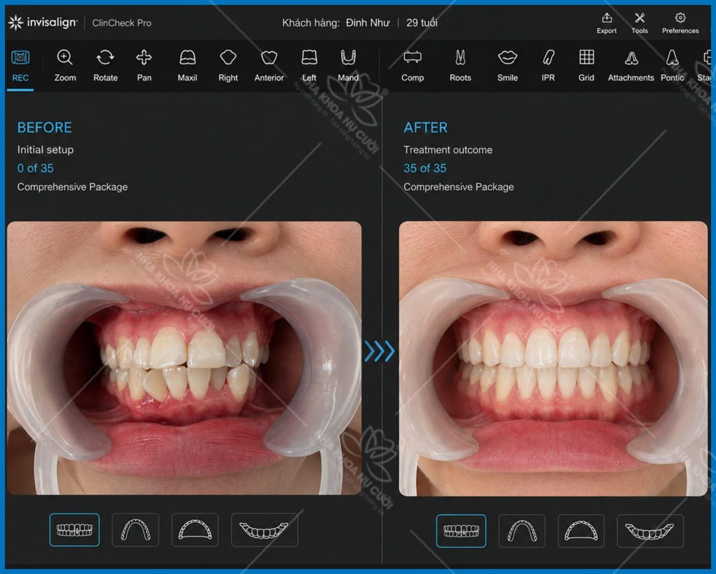 clincheck-invisalign-hai-phong
