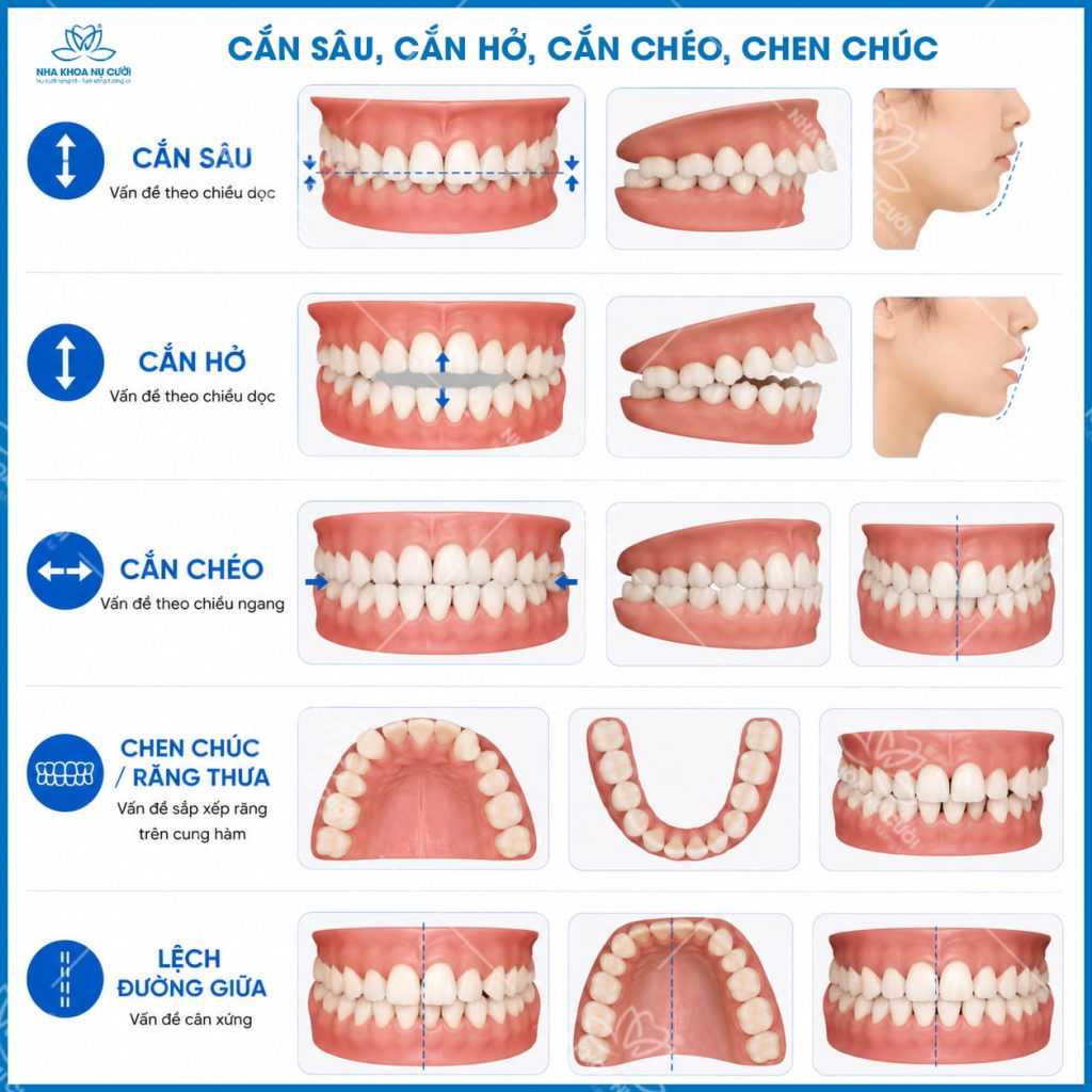 can-sau-can-cheo-can-ho-chen-chuc