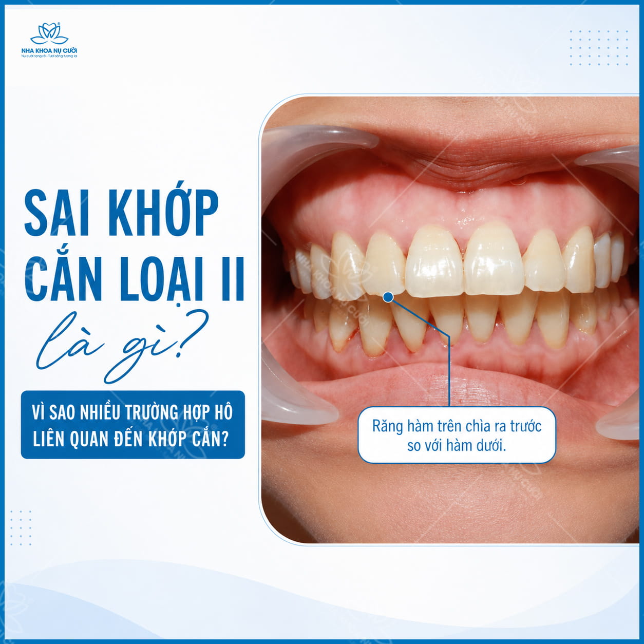 Sai khớp cắn loại II là gì? Vì sao nhiều trường hợp hô liên quan đến khớp cắn?